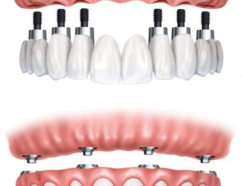Conoce más sobre la prótesis dental híbrida