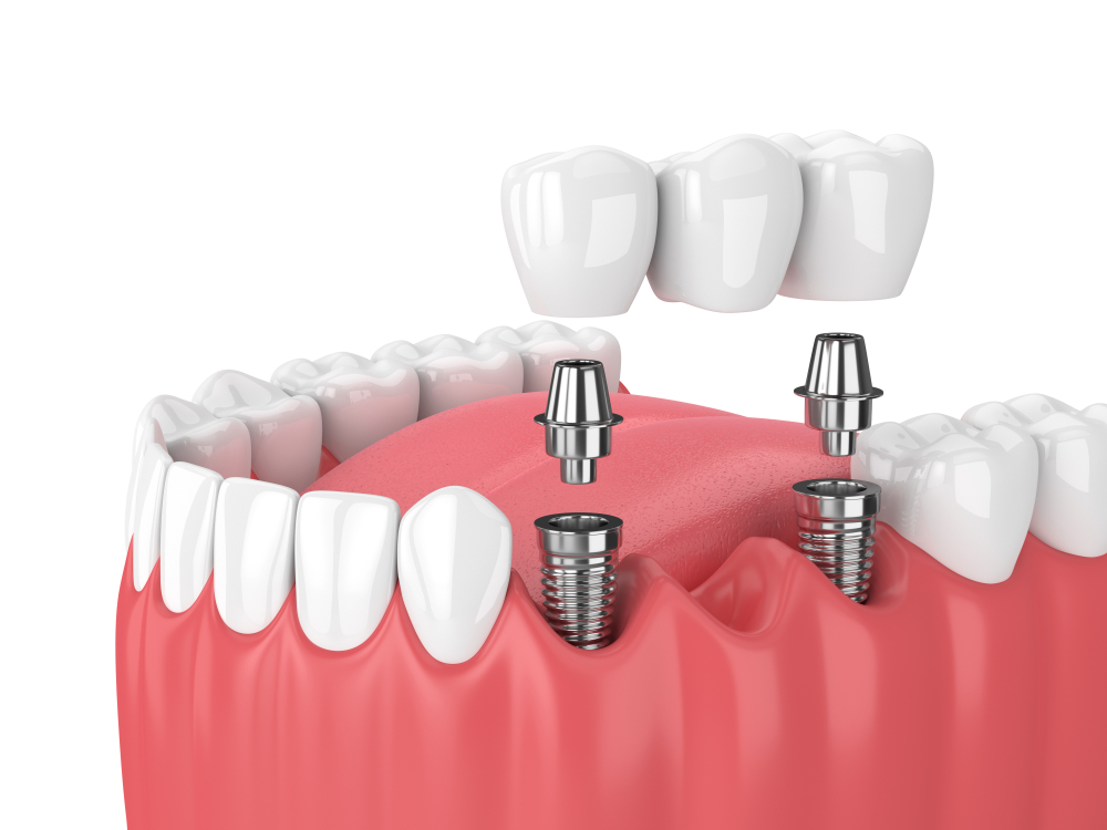 Puente dental sobre implantes