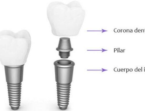 ¿Cuál es el pilar en un implante dental?