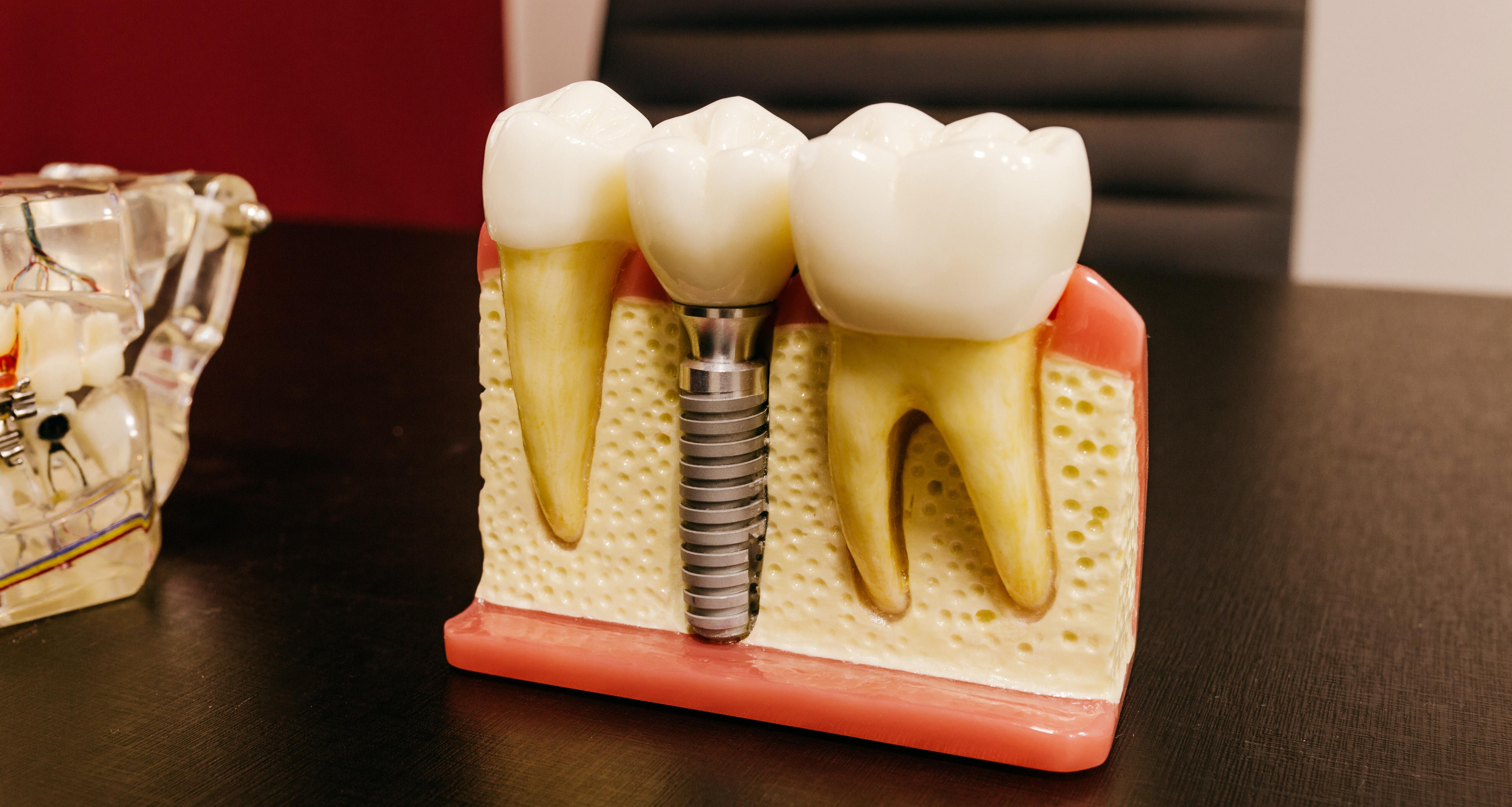 por-que-se-mueve-la-corona-dental-del-implante-causas-y-soluciones